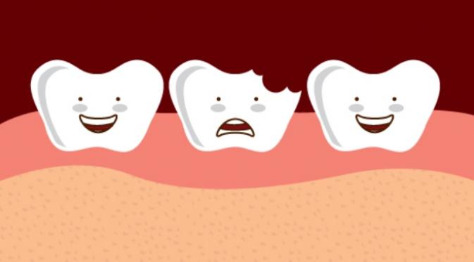 Ini Dia 3 Penyebab Gigi  Berlubang yang Sering Kita Alami