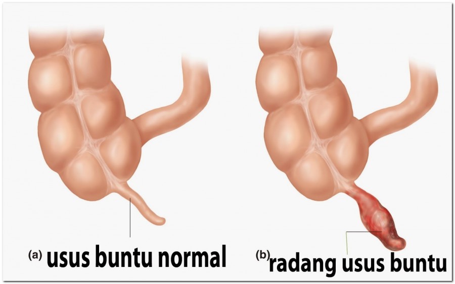 Pengertian Dan Cara Mencegah Penyakit Usus Buntu Atau Apendisitis